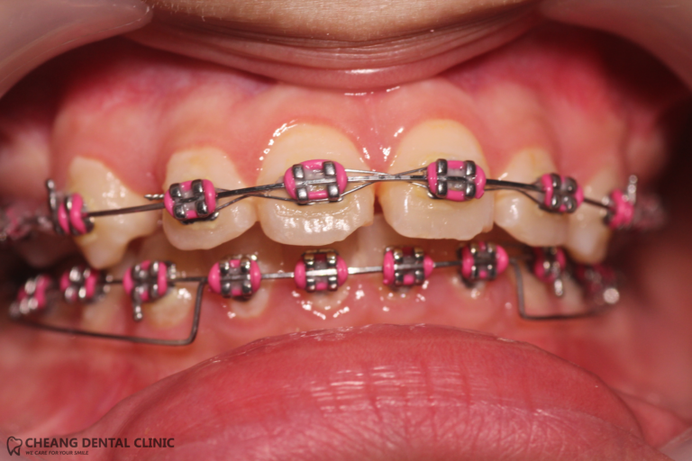 Conventional Teeth Braces